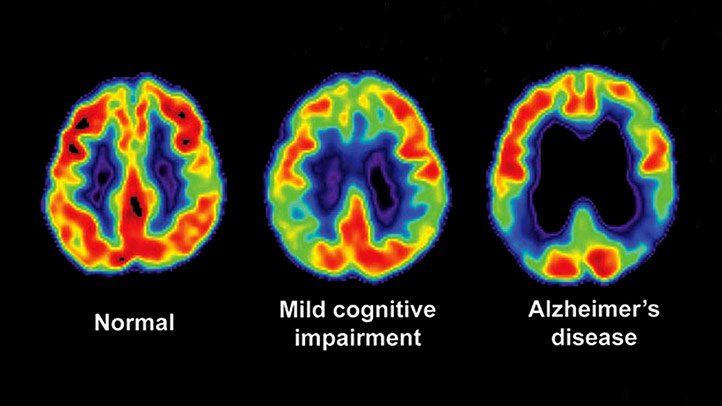Tahapan dan Diagnosa Alzheimer